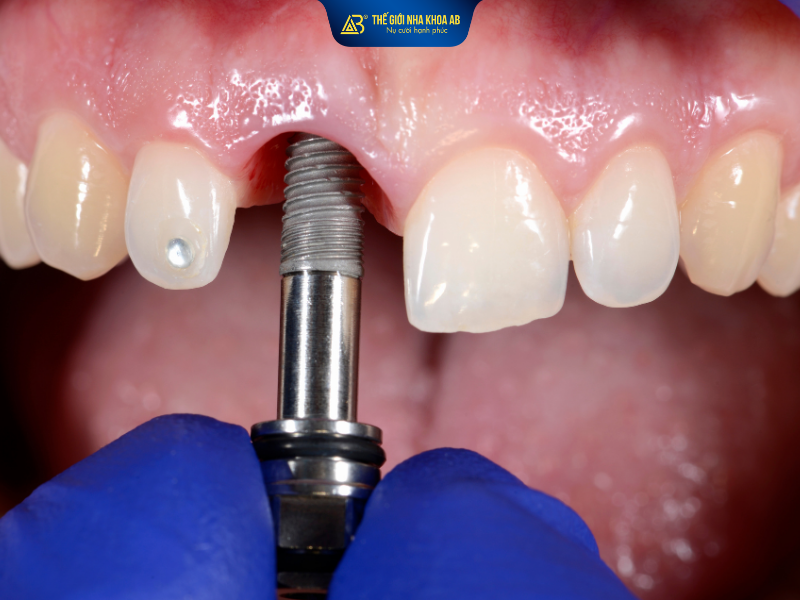 Trồng răng implant là cấy trụ implant vào xương hàm