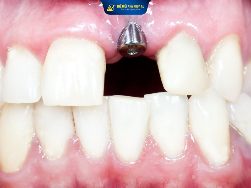 Trồng răng implant gặp biến chứng khi làm tại các cơ sở kém chất lượng