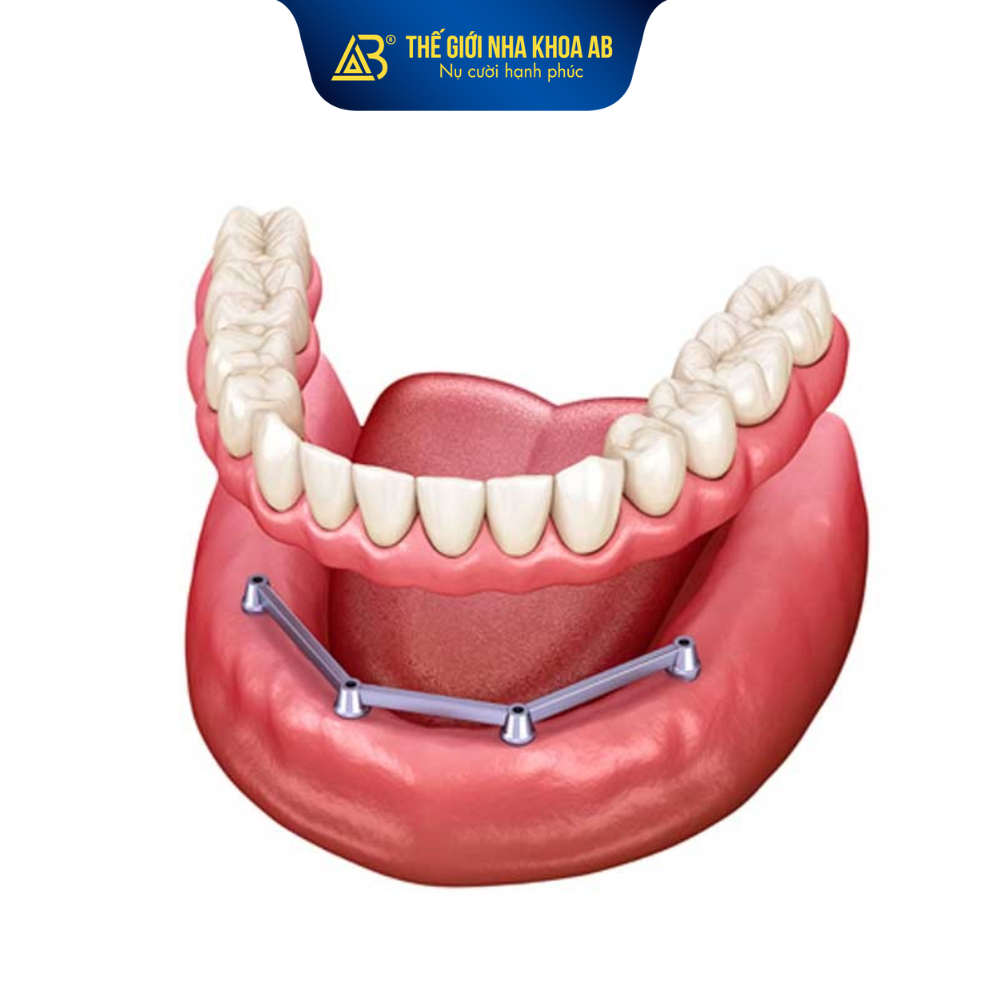 Hàm tháo lắp trên implant