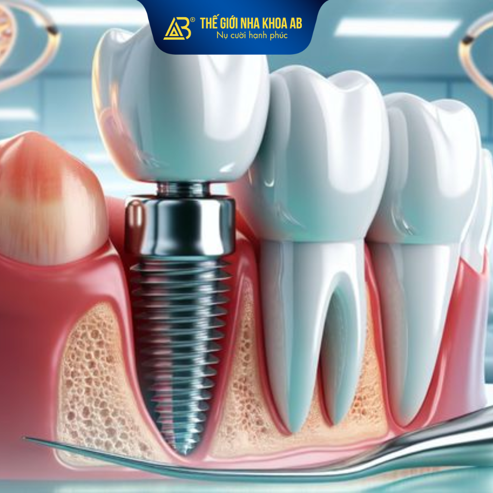 Cấy Implant tức thì là gì?