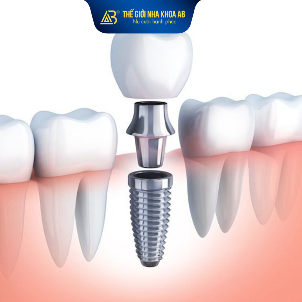 Ưu điểm của cấy Implant tức thì