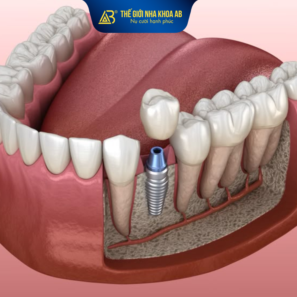 Nhược điểm của cấy Implant tức thì