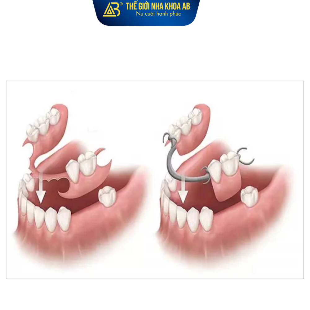 Hàm tháo lắp không vừa vặn
