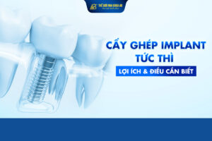 Cấy Ghép Implant Tức Thì