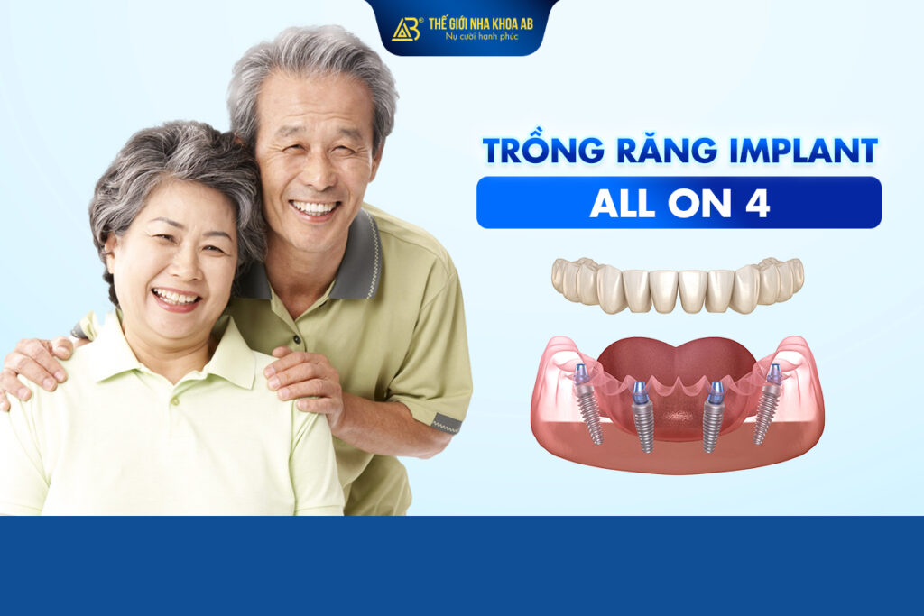 Trồng Răng Implant All On 4