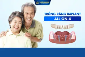 Trồng Răng Implant All On 4
