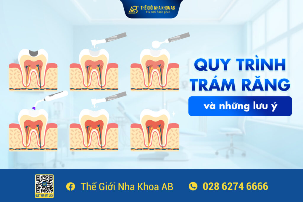 Quy TrÌnh TrÁm RĂng VÀ NhỮng LƯu Ý