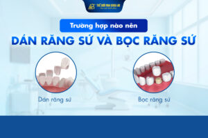 TrƯỜng_hỢp_nÀo_nÊn_dÁn_rĂng_sỨ_vÀ_bỌc_rĂng_sỨ