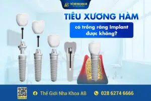 Tiêu_xương_hàm_có_trồng_răng_implant_được_không