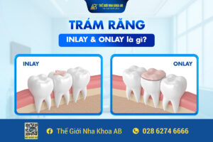 TrÁm_rĂng_inlay_vÀ_onlay_lÀ_gÌ