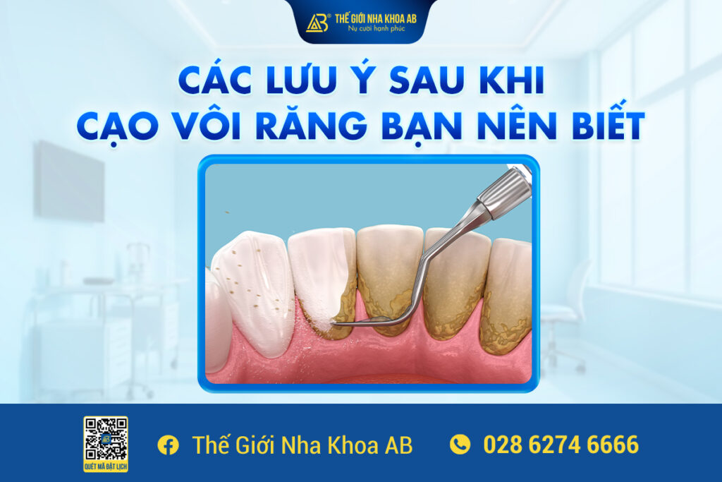 Các Lưu Ý Sau Khi Cạo Vôi Răng Bạn Nên Biết