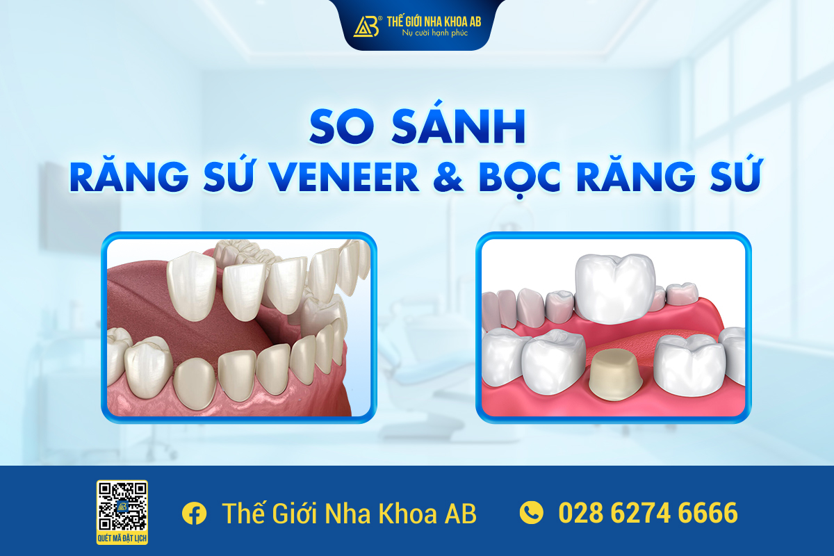 SO SÁNH DÁN RĂNG SỨ VENEER VÀ BỌC RĂNG SỨ