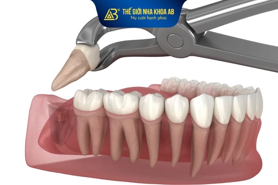 Nhổ răng khôn hàm dưới sẽ không gây nguy hiểm nếu được thực hiện đúng quy trình