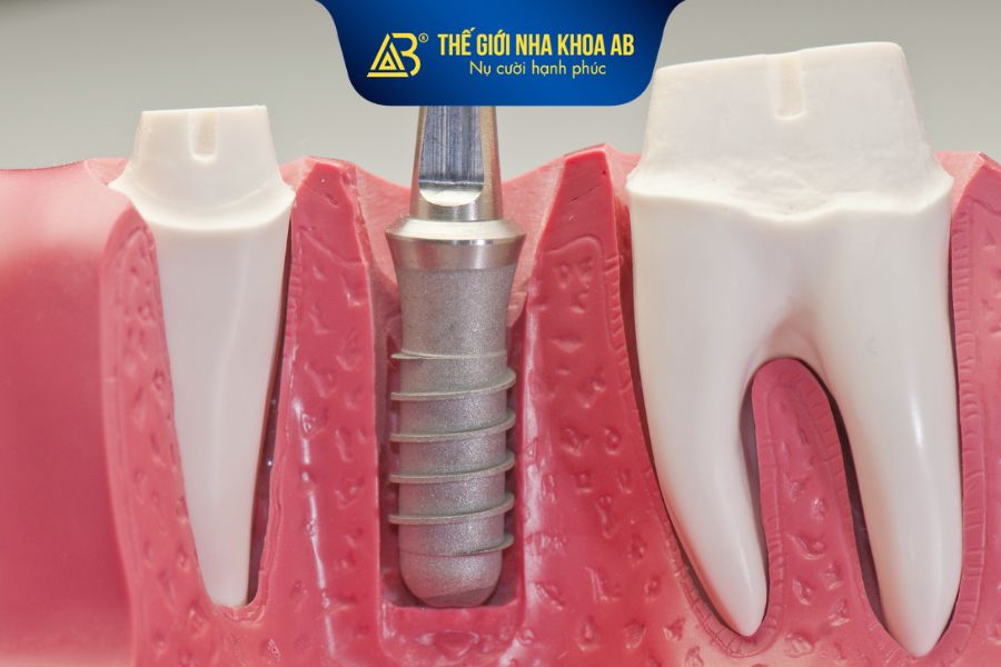 Trụ Implant Mỹ – Đức thuộc phân khúc cao cấp có giá từ 25 – 45 triệu đồng