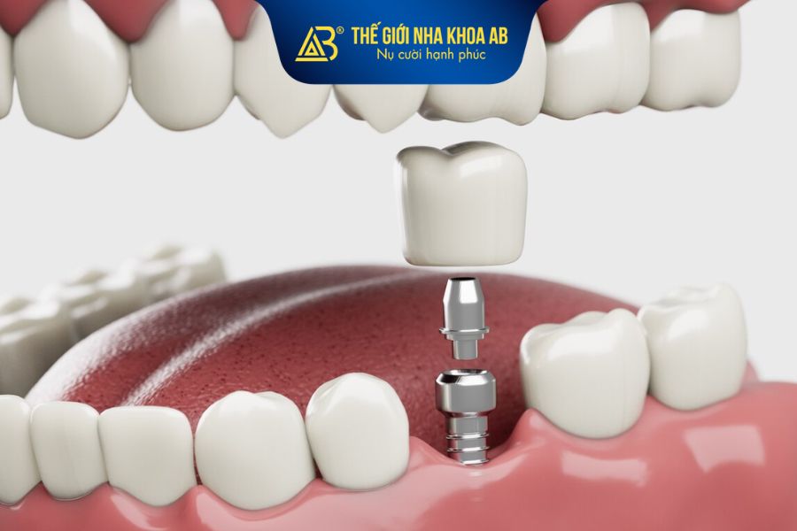 Trụ implant được sử dụng có ảnh hưởng trực tiếp đến giá cấy ghép implant