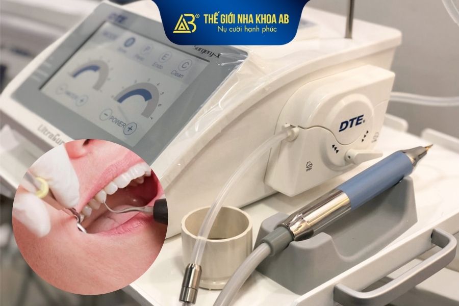 Nhổ răng khôn hàm dưới không đau bằng công nghệ sóng siêu âm Piezotome