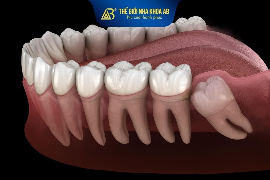 Răng khôn hàm dưới là chiếc răng số 8 nằm sâu phía trong