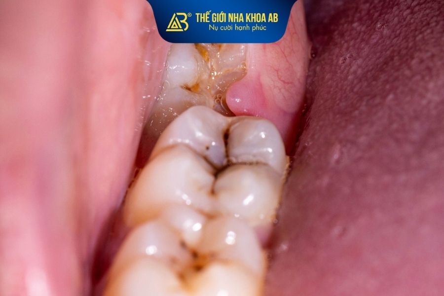 Răng khôn bị sâu cần được nhổ đi để tránh vi khuẩn lây lan sang răng thứ 7