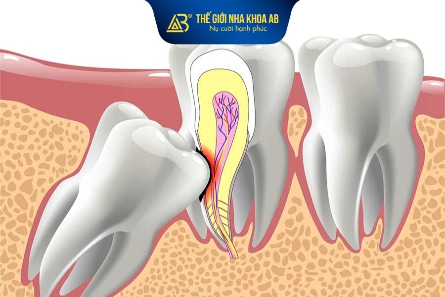Nên loại bỏ những chiếc răng khôn bị mọc ngầm hoặc mọc lệch