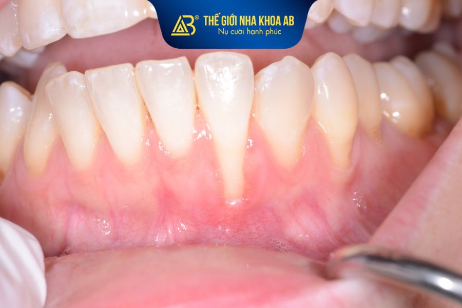 Chi phí trồng răng implant sẽ bị ảnh hưởng bởi tình trạng xương hàm và mô nướu
