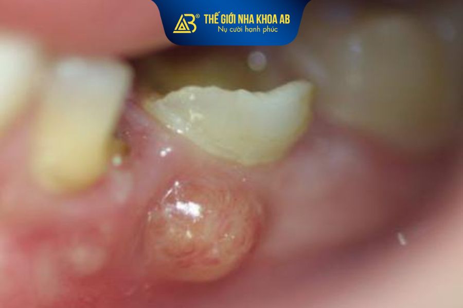 Viêm cấp tính như áp xe nướu cần được điều trị trước khi nhổ răng khôn