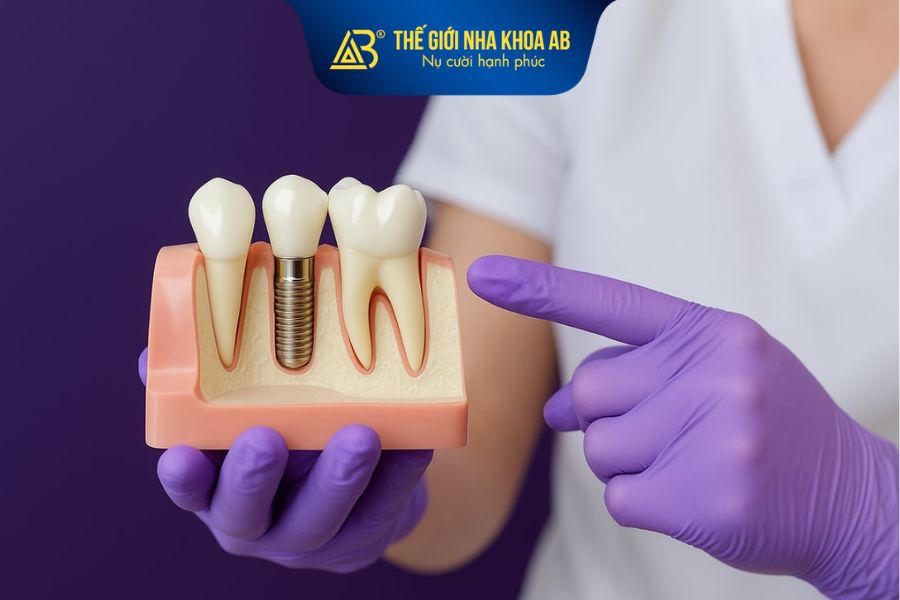 Chi phí cấy ghép implant thường cao vì được chế tác phức tạp