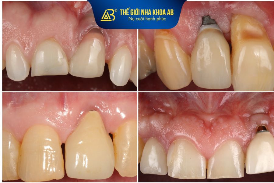 Một số biến chứng do sử dụng trụ implant giá rẻ