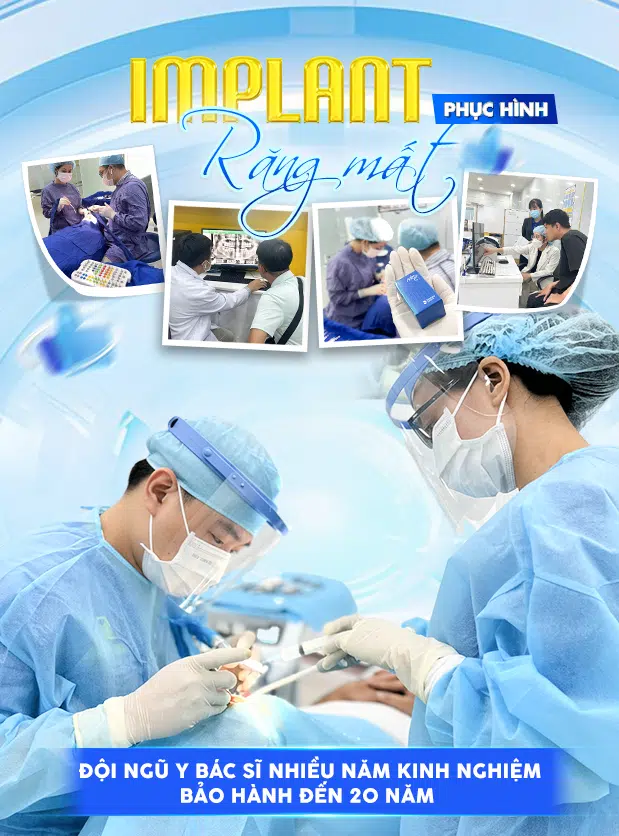 Implant phụ hình răng mất