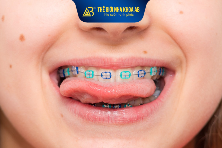 Niềng răng mắc cài cho trẻ giúp chỉnh răng và khớp cắn một cách toàn diện