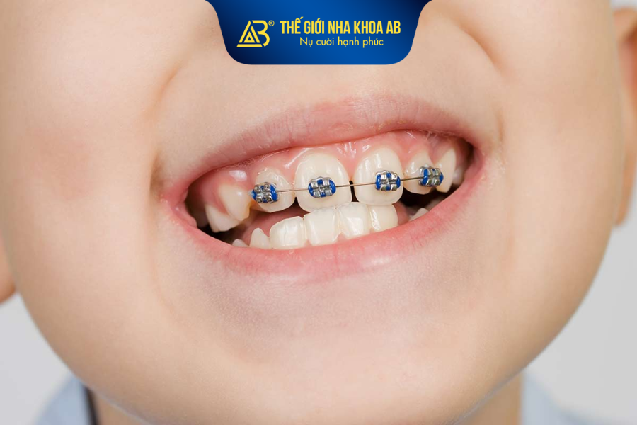 Chọn niềng răng trẻ em khi răng của trẻ có tình trạng mọc thưa, mọc không đều