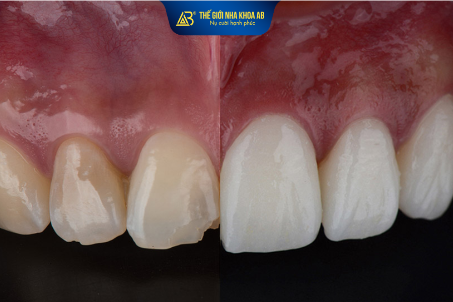 Dán sứ veneer có thể cải thiện tình trạng răng mẻ nhẹ, răng xỉn màu