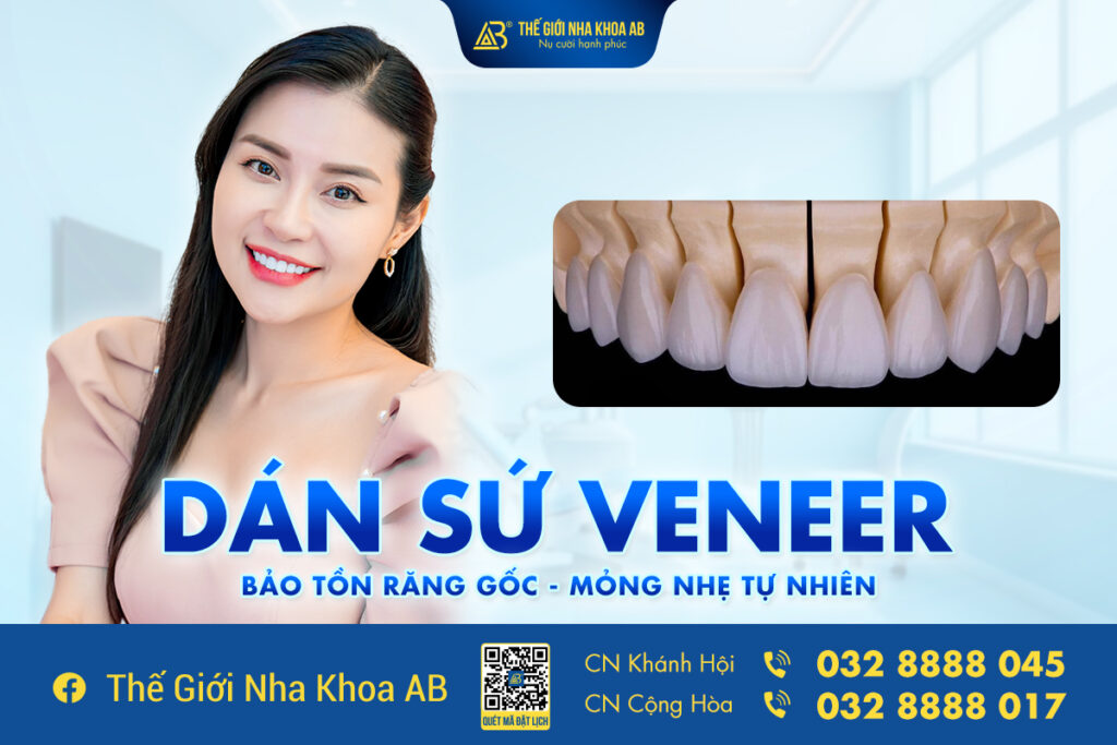 Dán Sứ Veneer