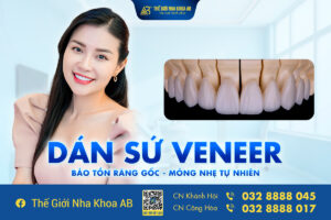 Dán Sứ Veneer