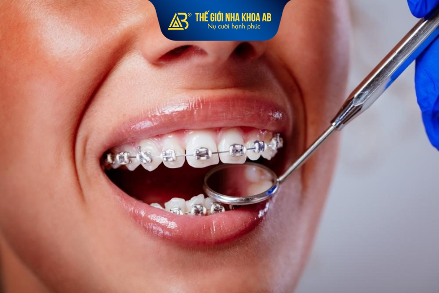 Niềng răng mắc cài truyền thống là phương pháp chỉnh nha được nhiều người lựa chọn