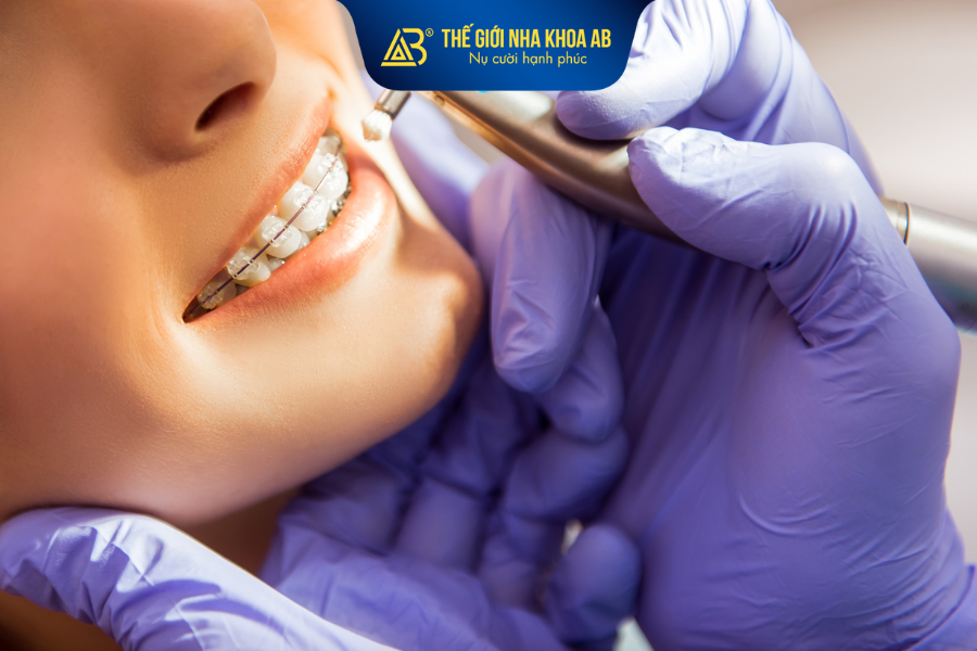 Mắc cài sứ là lựa chọn mang tính thẩm mỹ cao hơn mắc cài kim loại thông thường