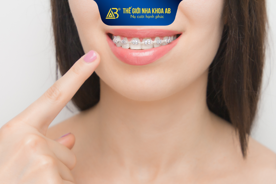 Không có loại mắc cài tốt nhất cho tất cả mọi trường hợp chỉnh nha