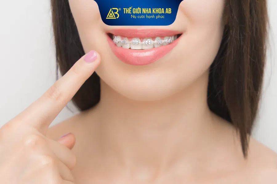 Không có loại mắc cài tốt nhất cho tất cả mọi trường hợp chỉnh nha