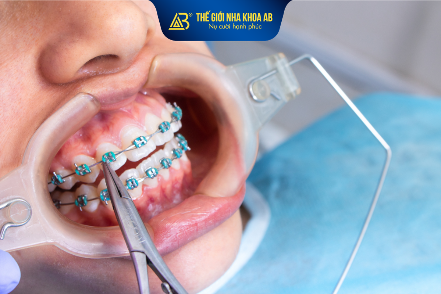 Lựa chọn nha khoa ứng dụng công nghệ hiện đại sẽ giúp quá trình niềng răng diễn ra chuẩn xác, an toàn