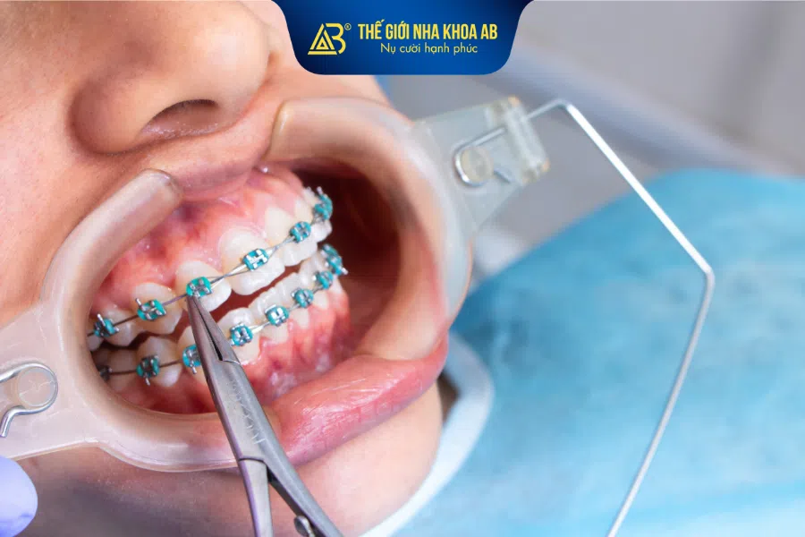 Lựa chọn nha khoa ứng dụng công nghệ hiện đại sẽ giúp quá trình niềng răng diễn ra chuẩn xác, an toàn