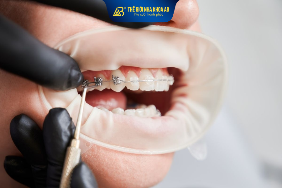 Những điều cần biết trước khi quyết định niềng răng mùa hè