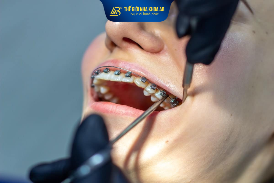 Nên niềng răng vào thời điểm phát hiện ra răng mọc sai lệch trên cung hàm