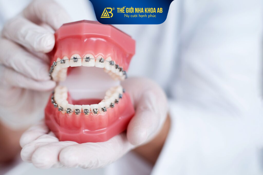 Một số tiêu chí quan trọng trước khi chọn “nên niềng răng mắc cài nào”